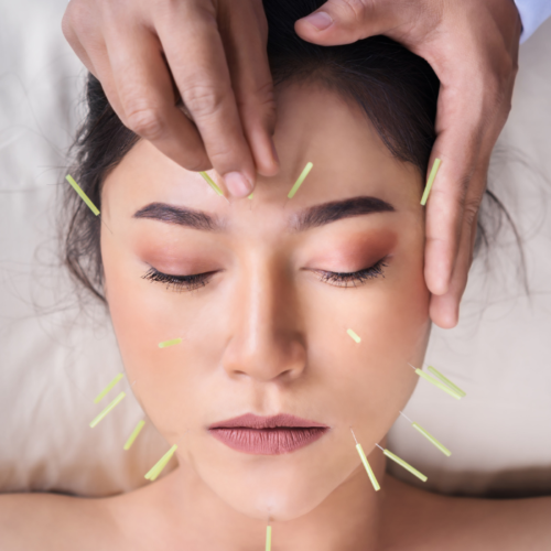 Acupuntura de mejillas - tratamiento facial con agujas